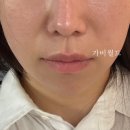 w-18 | W.18 압구정피부과 티타늄리프팅 후기