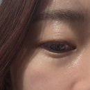 캐치웨이브 | 명동피부과ㅣ눈밑꺼짐필러 대신 선택한 힐로웨이브 후기 및 효과