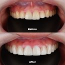 나치과 | 나한테 딱 맞는 퍼스널 라미네이트 '뉴엔치과' 라미네이트하고 매우 만족한 후기