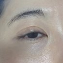 삼성안과의원 | 또 콩다래끼라니.. 올해 두 번째 제거 후기 | 잠실새내 삼성안과의원 내돈내산