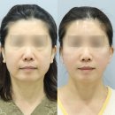동우메디칼 | 안면거상잘하는곳 선택하는 2가지 기준, 대표원장이 직접 알려드립니다.