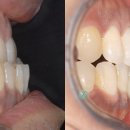 설측교정,콤비교정,돌출입교정, 치아교정 잘 하는 치과 연치과의 주걱턱 & 비대칭 치료 이미지