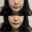 방배역 | 방배역 피부과 이브타이탄 리프팅 솔직후기