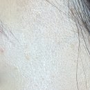 1265 | 편평사마귀 무제한 제거 리터치 후기(여신티켓 추천인 : PI25FFF9)