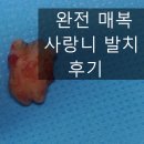 명인치과의원 | 남원 치과 완전 매복 사랑니 발치 후기 치과의사 직접 경험을 바탕으로