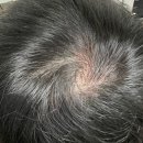 새희망약국 | 로게인폼 사용법