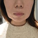 디지털스킨 | 구로디지털단지역 피부과 피부관리 후기(슈링크유니버스/스킨보톡스/턱보톡스/윤곽주사)