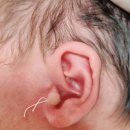 [치료 후기] 신생아 스킨택(skin tag, 쥐젖) 제거_세종 꿈담소아청소년과