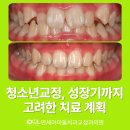 위스마일치과교정과치과의원 | 뚝섬역치과 청소년교정, 성장기 뼈나이까지 고려한 치료 계획