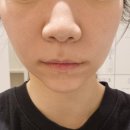 분당-300 | 분당 피부과 통증 없이 고주파 세르프 리프팅 300샷 후기