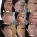 의정부기미잡티제거 제로스팟 미작뷰티 솔직후기