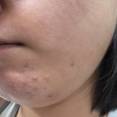 경기도 수원시 팔달구 효원로 288 (인계동) | 수원 인계동 모공리액터 통증,유지기간, 성인여드름 치료 1회차후기