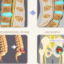 좌골신경통 좌골 신경통 원인 증상 치료 허리 디스크로 오인하는 좌골신경통 이미지