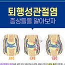 퇴행성관절염과 류마티스관절염 증상과 약물치료 이미지