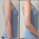 멍 클레어 | 팔뚝 부유방 지방추출주사 한달 후기 멍 흉터 회복과정