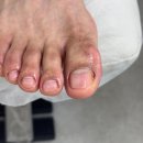 푸스케어 여주오학점 - 135559 | 발톱이 부서져서 방문한 여주 발톱무좀 전문 <푸스케어 여주오학점> 만족후기