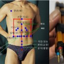 Re: 쿠싱증후군 간포인트 복모혈 이미지