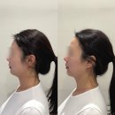 더하다한방병원 | [고양-덕양] 티리온온다 리프팅 후기 화정신부관리 "루미너스에스테틱"