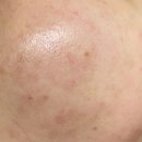 청솔메디칼 | 유스에스테틱 대구황금점에서 독일 플라즈마로 문제성 피부 관리 후기