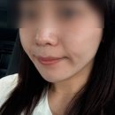 삼성맑은피부과의원 | 판교 피부과 통증없는 울쎄라 쿨소닉 리프팅후기