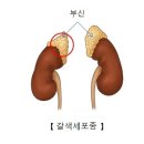 갈색세포종의 암보험금 .......??? 이미지