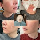 로담한의원에서 새살침 코라테라피 4번째 후기, 실제 느낀 점들