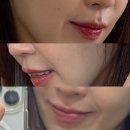 아리송 | 올타이트 리프팅 찐 내돈내산 후기 (2차) 여전히 아리송한 결과
