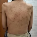 약초약국 | 니조랄 등드름 효과 부작용 약초필링 에센스 비교 후기