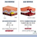 황반변성 초기 증상 치료 수술 이미지