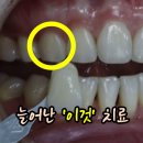 우리가족치과의원 | 도곡동치과, 누런치아 미백 방법과 효과/ 실제사례/전후사진후기 -의사직접작성