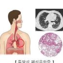 숨쉬기 힘들어요, 진폐증 폐섬유화 (폐, 잦은 기침 가래, 가슴 답답함) 이미지