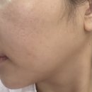 요한악세사리 | 창원피부과 볼뉴머 솔직후기