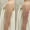 이루다에스테틱 | [연제구에스테틱] 이루다움에스테틱 : 여름 팔뚝관리 후기