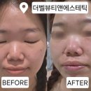 더벨뷰티앤에스테틱 | 구미 피부샵 더벨뷰티앤에스테틱, 여드름압출 관리 후기✨