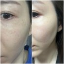 루비 | 루비레이저 후기, 가격대비 대만족! 잡티해결, 다운타임x