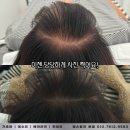 밀스칼프 이미지