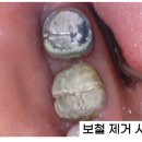 동탄본치과의원 | 동탄 영천동 치과, 잇몸 염증 고름 해결한 찐 치료 후기