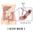 장간막 동맥 혈전증 이미지