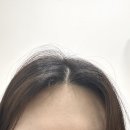 하이퍼들 | 레스노베 하이퍼샷 2주 사용 후기 헤어두피 디바이스 효과