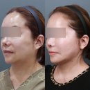 거상광고 | 안면거상수술, 후기만 보면 놓치는 2가지 기준