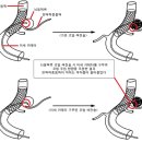 뇌동맥류 부작용 줄이는 치료법 ﻿공개 이미지