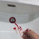 활기찬의원 | 채칼 손베임 ㅠ 병원 다녀온 후기 :: 창원 중앙역 활기찬 마취통증의학과 정형외과