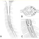 Re:Re:Volume change theory for syringomyelia: A new perspective 이미지