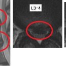 이상만 님의 요추디스크 L3-4, L4-5의 MRI사진 판독입니다. 이미지