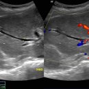 Cholangiocarcinoma 이미지