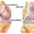 퇴행성관절염이란 무엇이며 퇴행성관절염증상은 어떤 것일까? "퇴행성관절염 바로알기" - 강남관절염전문병원 연세사랑병원 이미지