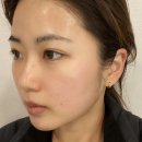 세븐일레븐대전천동점 | 대전 동구 레이저토닝 피부관리 “플레이스킨 천동점” 엑스터 레이저 어붐야그 후기 (데콜테 마사지 맛집)