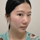 강남-200 | 강남피부과 통증없는 울쎄라 울트라인 200샷 후기!