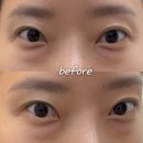 지우개의원 | 망원역 오로지의원 다크서클 지우개 다크필러 솔직후기 (전후 사진 있음)