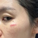 기치료 | 얼굴 봉합 흉터 레이저 첫 치료 후기｜레이저 치료 붉은기 상태 공개